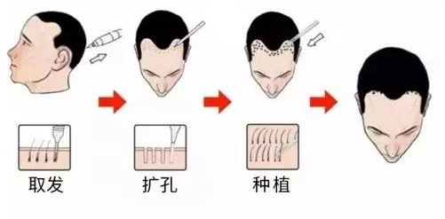 世界最新脱发治疗技术全解析，零基础入门，步步为营的治愈攻略